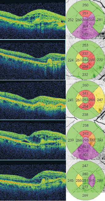 Ophthalmology Journal 2016, Vol. 1, Suppl. 2 12.2015 Stan wyjściowy VA: 0,6 CRT: 373 µm AT: 279,3 µm TV: 7,90 mm 3 01.2016 Po 1.