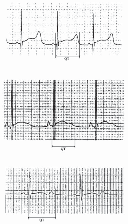 Folia Cardiologica Excerpta 2008, tom 3, nr 2 Rycina 2.