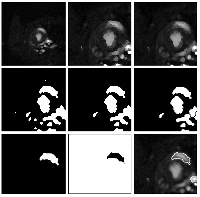 140 Fig. 4. Exemplary stages of analysis Rys. 4. Przykładowe etapy analizy Fig. 5. The graph illustrating ventricle area of images from one seria Rys. 5. Wykres przedstawiaj cy powierzchni komory dla obrazów jednej serii Graph (Fig.