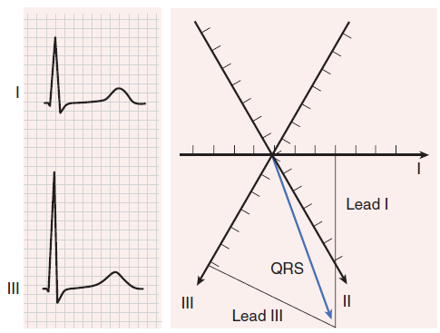 odejmowana od wartości maxymalnego wychylenia QRS dając średnią amplitudę QRS odpowiednio w I i w III odprowadzeniu 2.