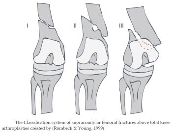 Rewizyjna endoprotezoplastyka kolana
