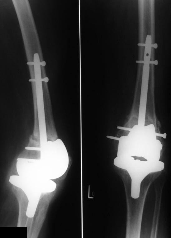 Leczenie Celem leczenia złamań okołoprotezowych kolan jest zarówno uzyskanie zrostu kostnego jak i