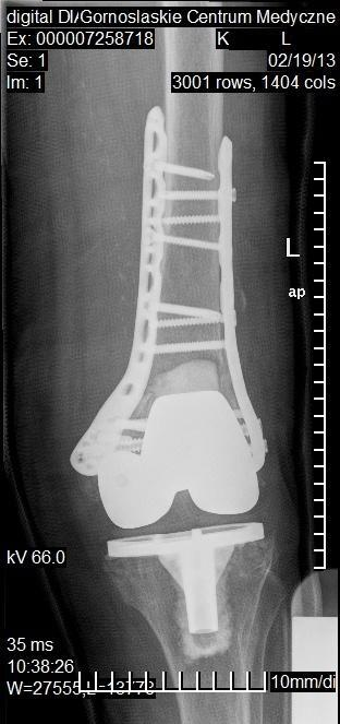 Leczenie Akceptowalne ustawienie odłamów: przemieszczenia fragmentów kostnych <5mm, przemieszczenia kątowe