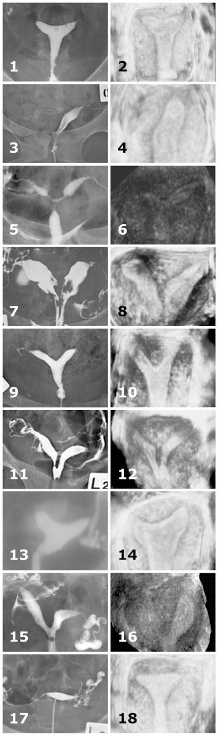 Ginekol Pol. 2014, 85, 354-359 P R A C E O R Y G I N A L N E Figure 1. Fig. 1/1. HSG image of a normal uterus. Fig. 1/2. 3D TV USG image of a normal uterus. Fig. 1/3.