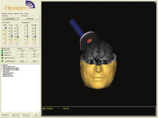 pola elektrycznego ma jedynie dalece przybli ony charakter. Rys. 10. System Magstim Brainsight TMS - metoda stymulacji TMS prowadzonej pod kontrol obrazu (image-guided TMS) [www.magstim.