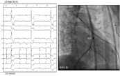 Folia Cardiologica Excerpta 2012, tom 7, supl.