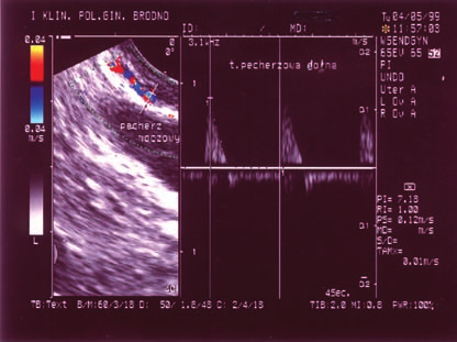 Tabela 1. Ocena wskaźnika RI w zakresie tętnicy pęcherzowej dolnej, przed i po leczeniu hormonalnym.