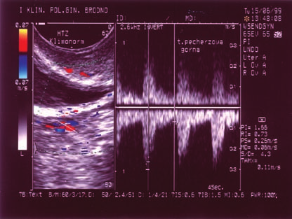 Ryc. 7. Rejestracja przepływów w tętnicy pęcherzowej górnej z oceną wskaźnika oporności RI po leczeniu hormonalnym.