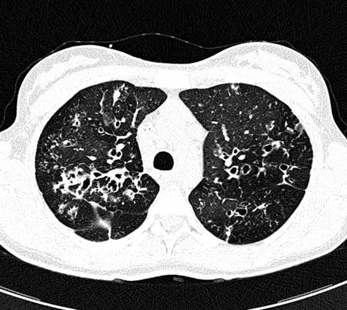 Plamiste obszary zwiększonej przejrzystości związane z mozaikową perfuzją Figure 3 A, B. High-resolution computed tomography of the lungs.