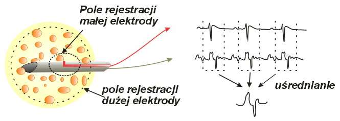 Macro EMG Duża elektroda rejestruje potencjał czynnościowy jednostki, a dzięki małej elektrodzie,