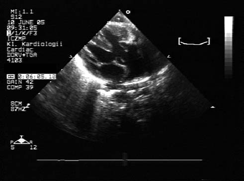 Ryc. 1. Badanie echokardiograficzne; projekcja podmostkowa: poszerzona tętnica płucna odchodząca znad ubytku międzykomorowego Ryc. 2.