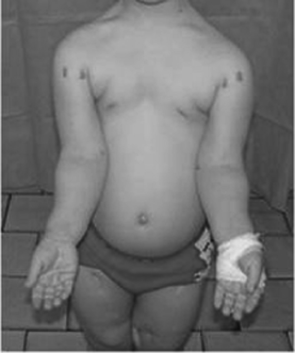 Picture of described patient: asymmetry of leg length and knee valgus tylko w somatotropinowej i wielohormonalnej niedoczynności przysadki, ale także w innych jednostkach chorobowych przebiegających