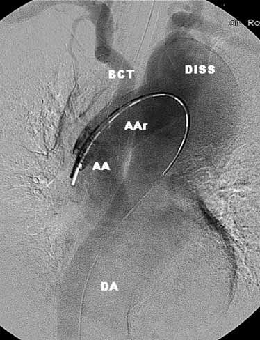Acta Angiol, 2010, Vol. 16, No. 3 Figure 1. Baseline angiography revealed descending aortic dissection.