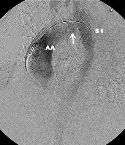 AA aorta wstępująca, AAr łuk aorty, BCT pień ramienno-głowowy, DA aorta zstępująca, DISS rozwarstwienie to 9 months and no further aortic dilatation has been noted (82 mm since July 2007).