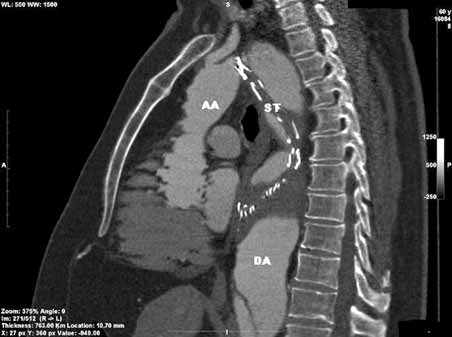 Thoracic stentgraft collapse, Juszkat et al. Figure 3. Complete stentgraft collapse at 3-month follow-up CTA. AA ascending aorta, DA descending aorta, ST stentgraft Rycina 3.