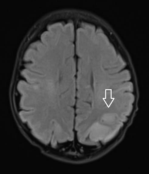 W trakcie pobytu u dziecka nie obserwowano zaburzeń neurologicznych.