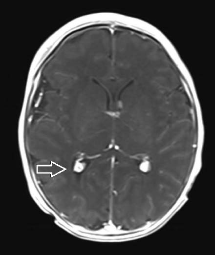 Katarzyna Piotrowska i wsp. Ryc. 5. Osiowy obraz w sekwencji FLAIR ukazuje guzy podwyściółkowe w komorach bocznych mózgu Ryc. 6.