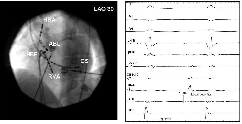 Ablacja częstoskurczu przedsionkowego w niewieńcowej zatoce aorty 211 A Rycina 2. A. Miejsce apliakcji w projekcji LAO 30.