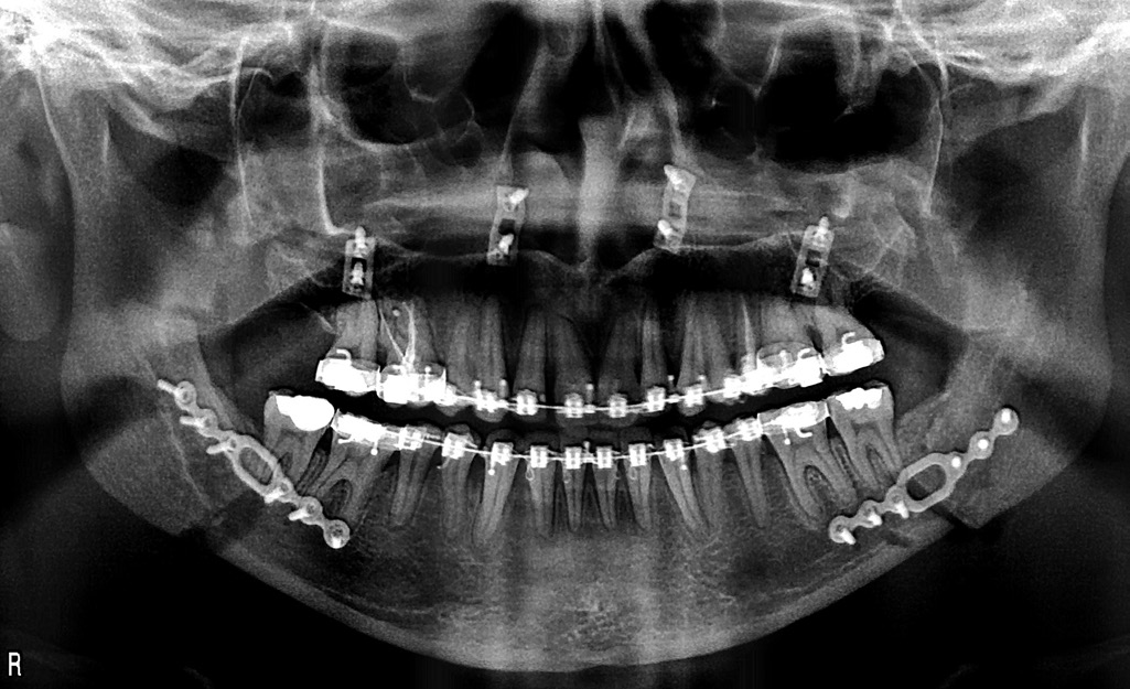 Osteosynthesis techniques used for mndiulr sgittl split osteotomy history of orthognthic procedures nd modern