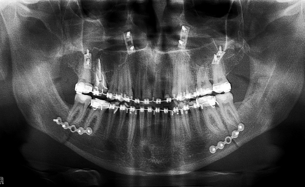 Monocorticl fixtion: ) doule plte osteosynthesis in ortho pntomogrm; ) doule plte osteosynthesis in situ FIGURE 10.