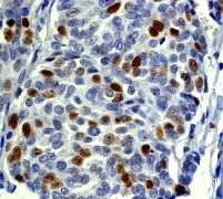 ab40890 (1/250) staining human breast carcinoma by immunohistochemistry, paraffin-embedded tissue. http://www.abcam.