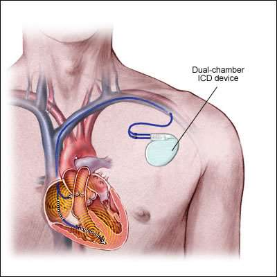 Implantowany kardiowerter-defibrylator w zapobieganiu nagłej śmierci sercowej prewencja pierwotna