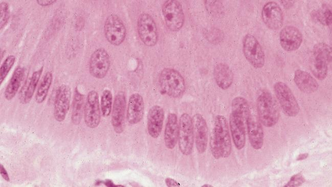 NASKÓREK - WARSTWA PODSTAWOWA (PODSTAWNA) Cytokeratyny (filamenty