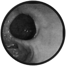 Rycina 2. Mnogie uchyłki jelita grubego w obrazie TK Figure 2. Colonic diverticula in picture CT Rycina 1. Pojedynczy uchyłek jelita grubego w obrazie endoskopowym Figure 1.