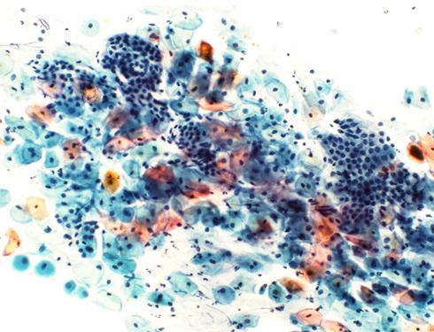 włókna kolagenowe, ziarna wydzielnicze w komórkach) - czerwone Rozmaz PAP służy do wykrywania odmian wirusa brodawczaka