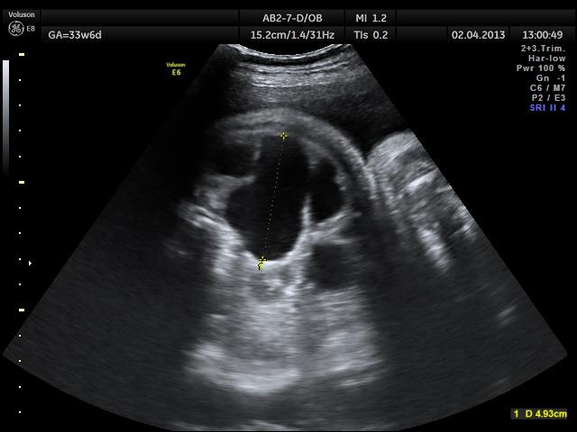 Rozpoznania ostatecznie - pourodzeniowe U dzieci z prenatalnym podejrzeniem wady układu moczowego stwierdza się: 1. Poszerzenie ukm idiopathic hydronephrosis 37%-88% 2.