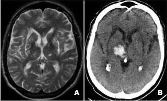 A. MRI przed krwawieniem (ogniska niemych