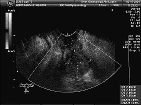 Ryc. 3. Przykład badania dopplerowskiego potwierdzonej histologicznie małej, centralnej wznowy raka endometrium w miednicy mniejszej u chorej w 21 mies. po histerektomii z przydatkami.