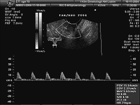 Przykład badania ultrasonograficznego relatywnie dużej, ale niewyczuwalnej w badaniu palpacyjnym centralnej wznowy raka endometrium u chorej w 8 mies. po histerektomii z przydatkami.