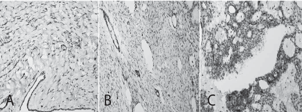 Figure 1. Immunohistochemical staining patterns with anti-caveolin-1 antibody: (A) stromal cells, (B) perivascular and, (C) cytoplasm of tumor cells (DAB x 100). Results Figure 2.