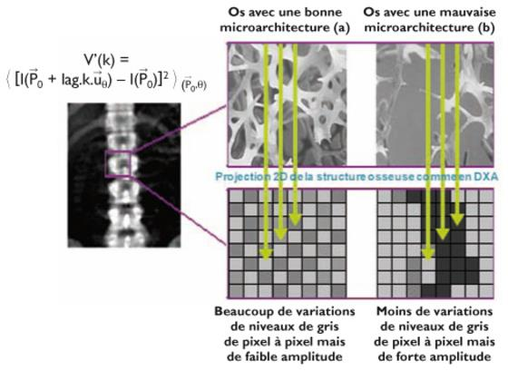 Trabecular bone score Ryzyko złamania Lumbar Spine Trabecular Bone Score (TBS) combined with FRAX improves fracture prediction: The Manitoba BMD Cohort. Leslie W et al.