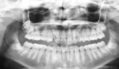 Bardzo często lekarze chirurdzy i ortodonci zadają sobie pytanie jakie jest położenie kła zatrzymanego podniebienne czy przedsionkowe?