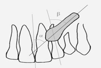 Rycina 5. Wskaźnik położenia kła zatrzymanego w stosunku do linii pośrodkowej wg Ericsona i Kurola (schemat i pantomogram) Figure 5.