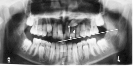 siekacza stałego przyśrodkowego (ryc.6). The distance of impacted canine to occlusal plane index is determined as length (d) and measured in millimeters.