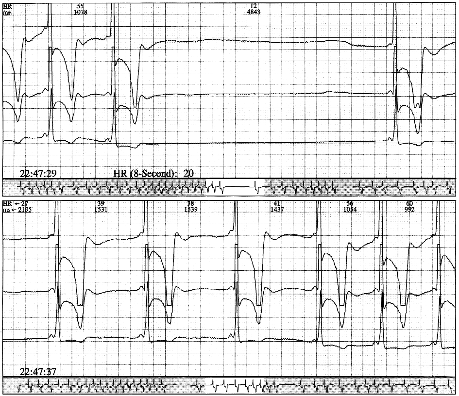 Elektrokardiogram w chorobie Fabry ego 689 Rycina 1.