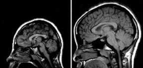 Geny mikrocefaliny i ASPM Mikrocefalia Chory 13 lat Zdrowy 11 lat Szybka