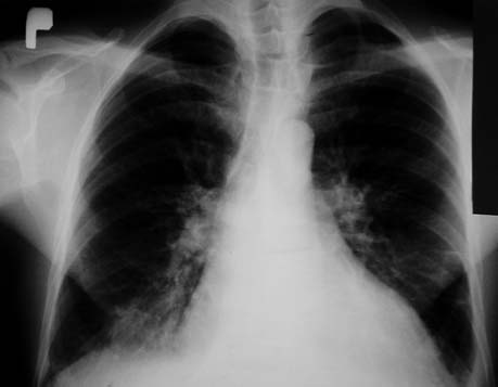 Istotne zwężenie zastawki aortalnej z małym gradientem ciśnienia i upośledzoną funkcją lewej komory 883 tową lewej komory ~15 20% i nadciśnienie płucne ~55 mmhg (Rycina 3.).
