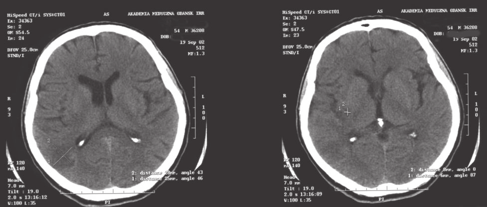 Udar Mózgu 2003, tom 5, nr 1 Rycina 3. Obraz tomografii komputerowej w 2 dobie hospitalizacji Figure 3. CT scans on 2 nd day after incident Rycina 4.