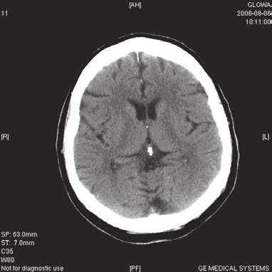 Udar Mózgu 2010, tom 12, nr 1 2 Rycina 1.,. adanie metodą tomografii komputerowej (CT) przy przyjęciu chorej na oddział Figure 1.,. Computed tomography (CT) scan during enrolling of patent to neurological department najgroźniejszego powikłania, jakim może być wtórne krwawienie śródmózgowe [9].