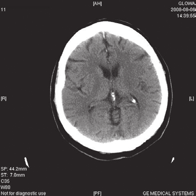Piotr Sobolewski i wsp., Zespół wieczka przedniego po leczeniu rt-pa Rycina 2.,. adanie metodą tomografii komputerowej (CT) wykonane po powtórnym incydencie udarowym Figure 2.,. Computed tomography (CT) scans after secondary stroke Rycina 3.