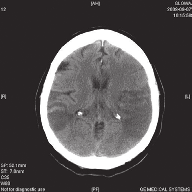 4) wykazała rozległe obustronne ogniska hipodensyjne, z bardziej nasilonymi objawami transformacji krwotocznej. Początkowo stan chorej był ciężki.
