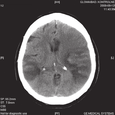 Udar Mózgu 2010, tom 12, nr 1 2 C D Rycina 4. D. adanie metodą tomografii komputerowej (CT) wykonane po 7 dniach Figure 4. D. Computed tomography (CT) scans after 7 days w zakresie gardła i podniebienia; zachowane były odruchy gardłowe i podniebienne.