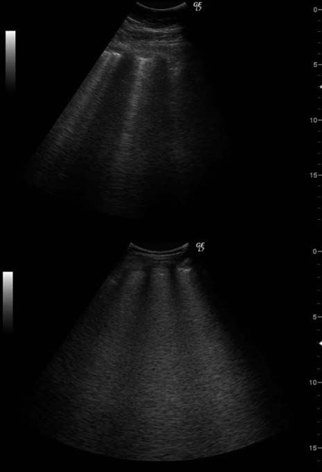 Pneumonologia i Alergologia Polska 2016, suplement I, strony A16 A24 Badanie ultrasonograficzne w obrzęku płuc okazuje się mieć przewagę nad RTG klatki piersiowej, zarówno pod względem czułości, jak