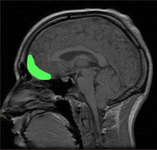 Struktury niespecyficzne Dolna część kory czołowej i kora oczodołowa (OFC orbitofrontal cortex) Lezja agnozja prozopoafektywna