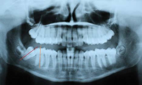 zębów trzonowych szczęki (1, 6).