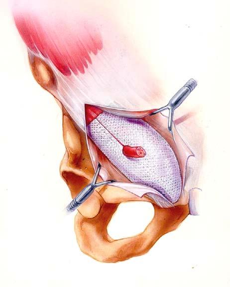 160 Tension-Free, Sutureless, Preshaped Mesh Herniopiasty RYSUNEK 15.2. Ukształtowana siatka ułożona bez szwów w zamkniętej przestrzeni nie ma możliwości przesuwania się.